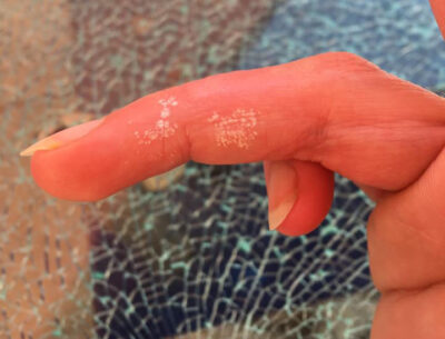 Weiße Finger nach Wasserstoffperoxid – Was wirklich dahintersteckt